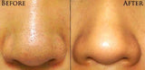 PoreVacuum™ Pore Cleanser & Blackhead Remover